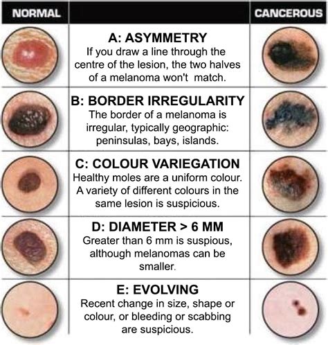 what diameter indicates melanoma